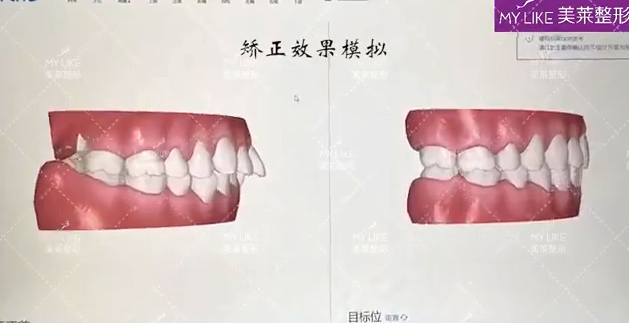 天津美萊口腔·專業(yè)口掃 預見矯正效果