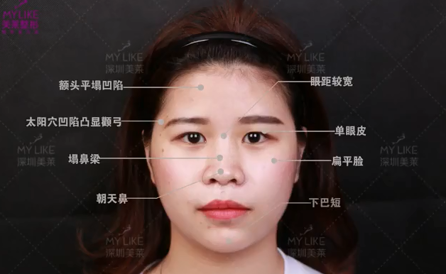 深圳美萊眼神全面改善，整體效果才能大大加分！