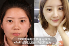 雙眼皮全切好還是埋線好？鄭州美萊割雙眼皮哪位醫(yī)生好？