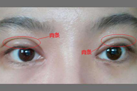 雙眼皮失敗了怎么辦？<a href='/zz/' target='_blank'><u>鄭州美萊</u></a>醫(yī)院助你重獲新生