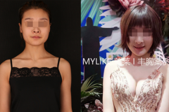 鄭州美萊整形假體豐胸和自體豐胸哪個(gè)好？