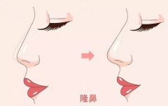 鄭州美萊整形醫(yī)院隆鼻有幾種、效果怎么樣？