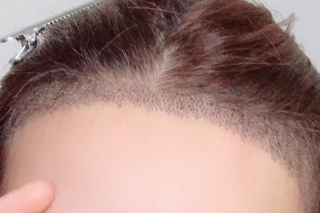 常州發(fā)際線調(diào)整效果好嗎，發(fā)際線如何調(diào)整？