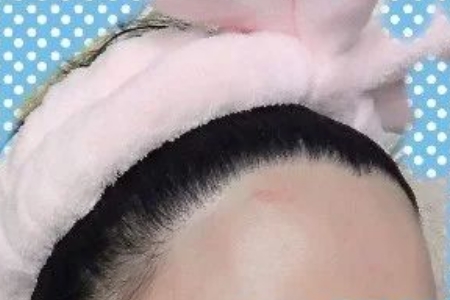 常州發(fā)際線調(diào)整效果好嗎，發(fā)際線如何調(diào)整？