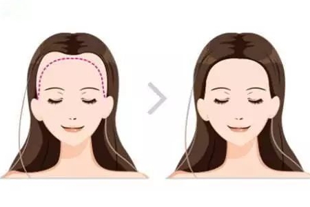 常州發(fā)際線調(diào)整效果好嗎，發(fā)際線如何調(diào)整？