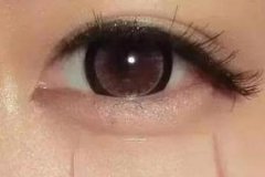 自體脂肪豐臥蠶填幾次有效果，術(shù)后注意事項(xiàng)有哪些