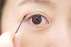 重慶割雙眼皮醫(yī)院手術(shù)多少錢，多久能恢復(fù)正常