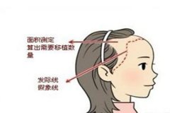 種植發(fā)際線哪家醫(yī)院口碑好，植發(fā)需要多少錢
